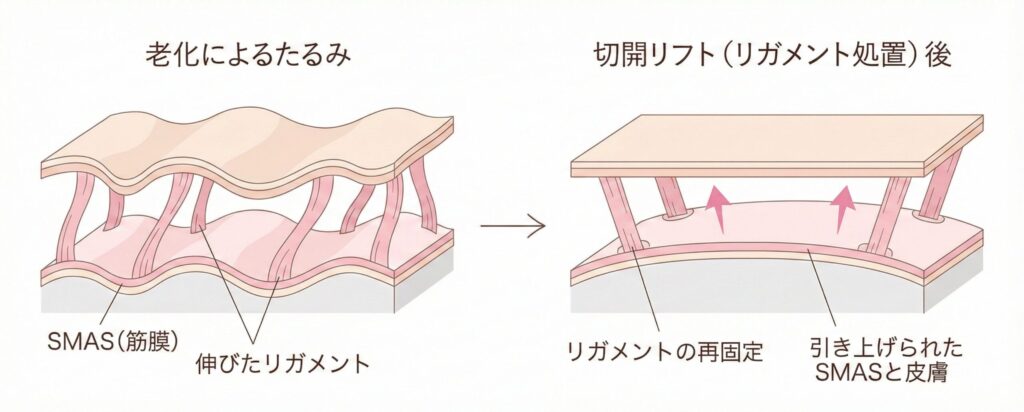 切開リフトの説明画像
老化によるたるみと処置後の状態の比較