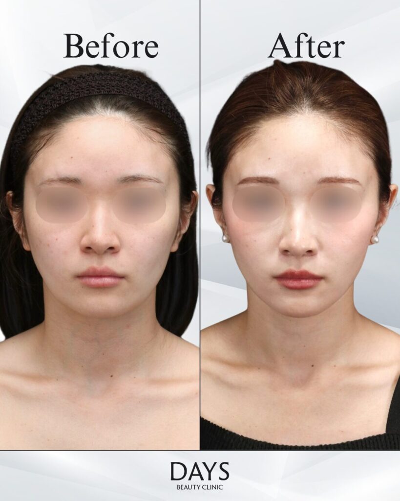 小顔　症例　20代女性