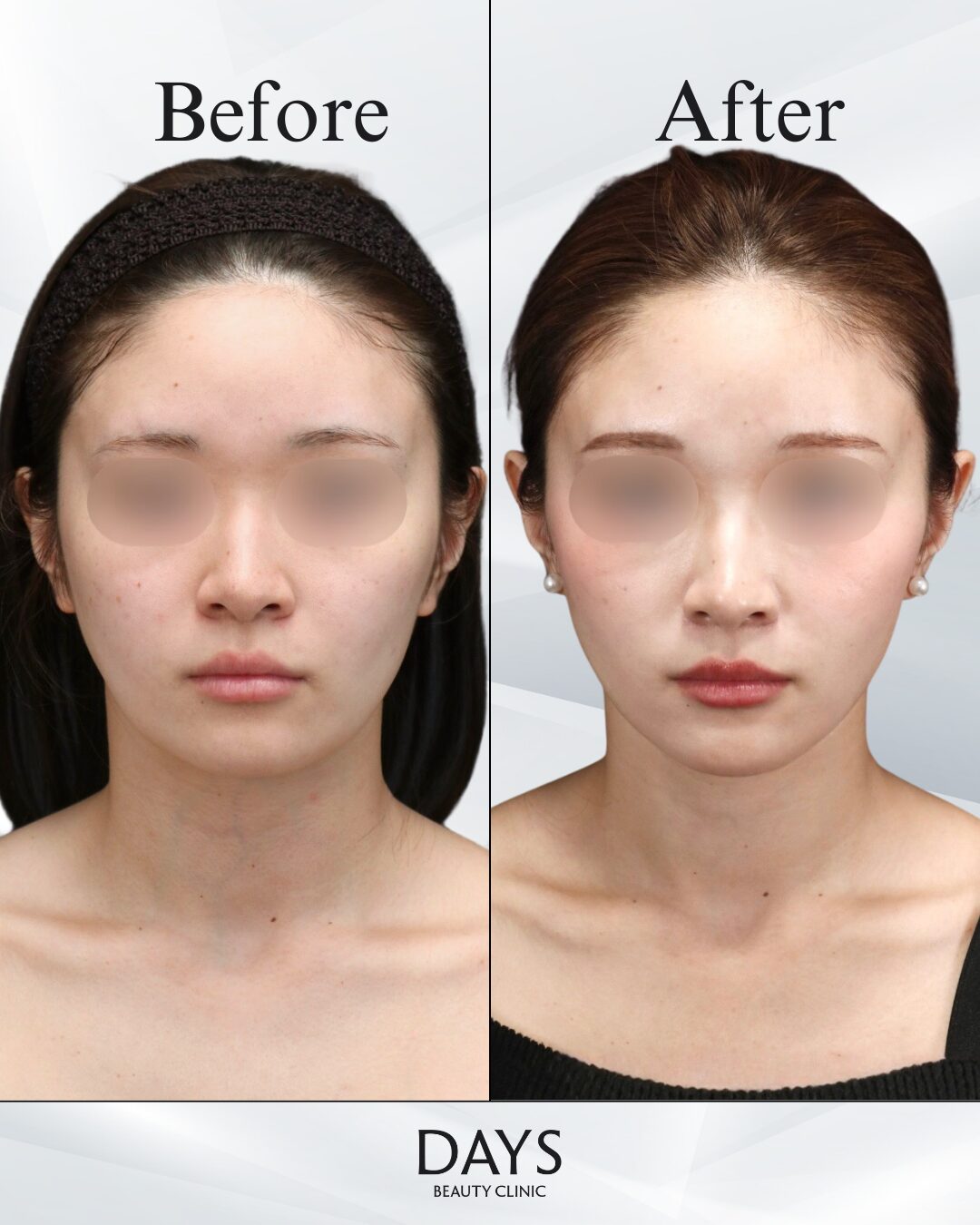 小顔脂肪吸引・糸リフト-1