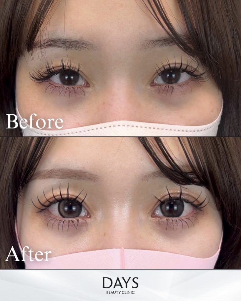 タレ目形成　症例　20代女性