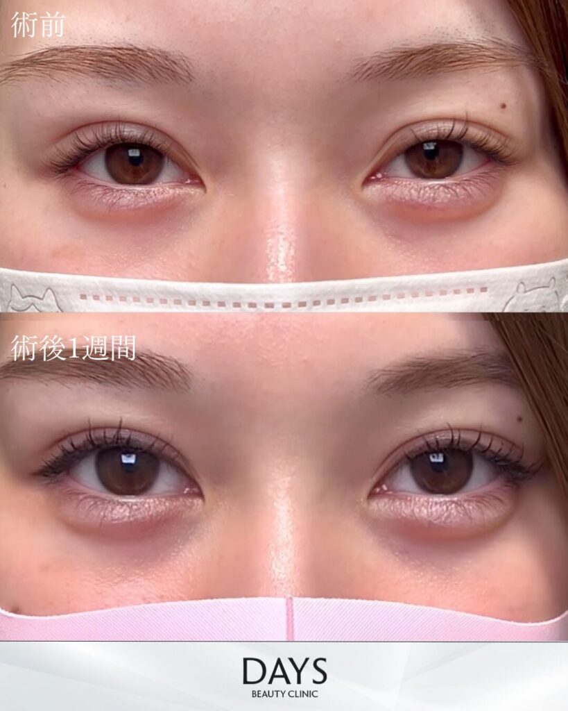 二重埋没　症例　20代女性