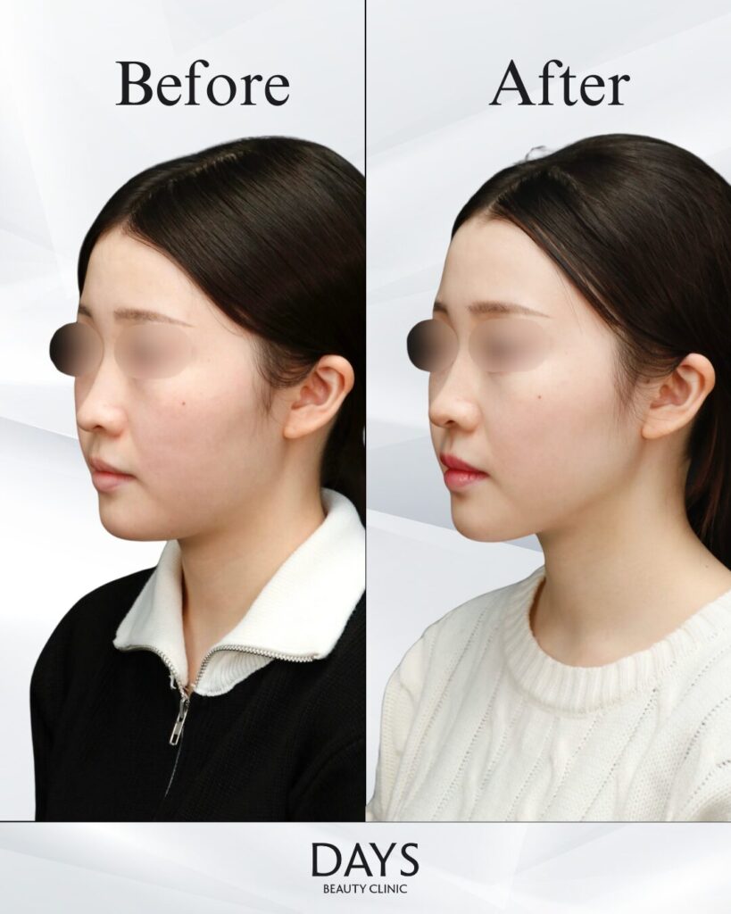 小顔　症例　20代女性