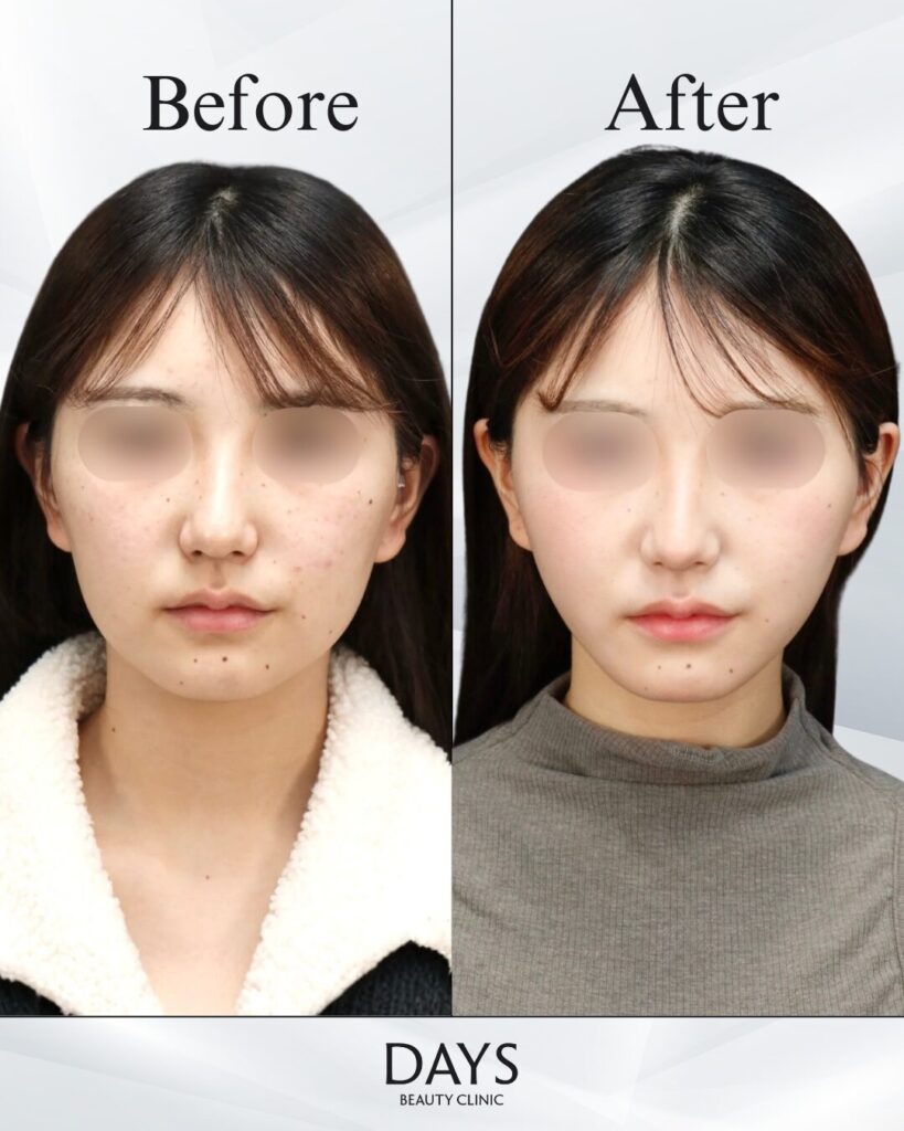 小顔　症例　20代女性