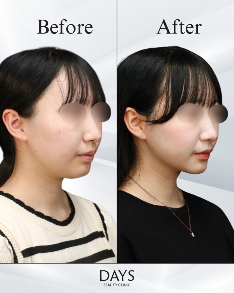 小顔　症例　20代女性