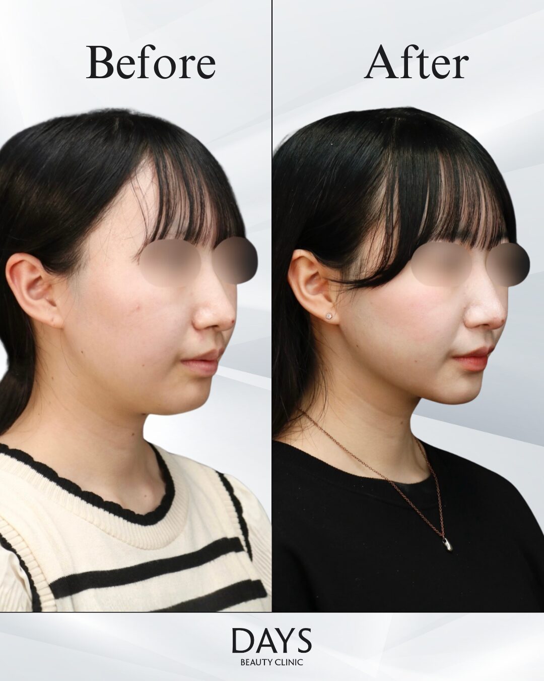 小顔脂肪吸引・糸リフト-3