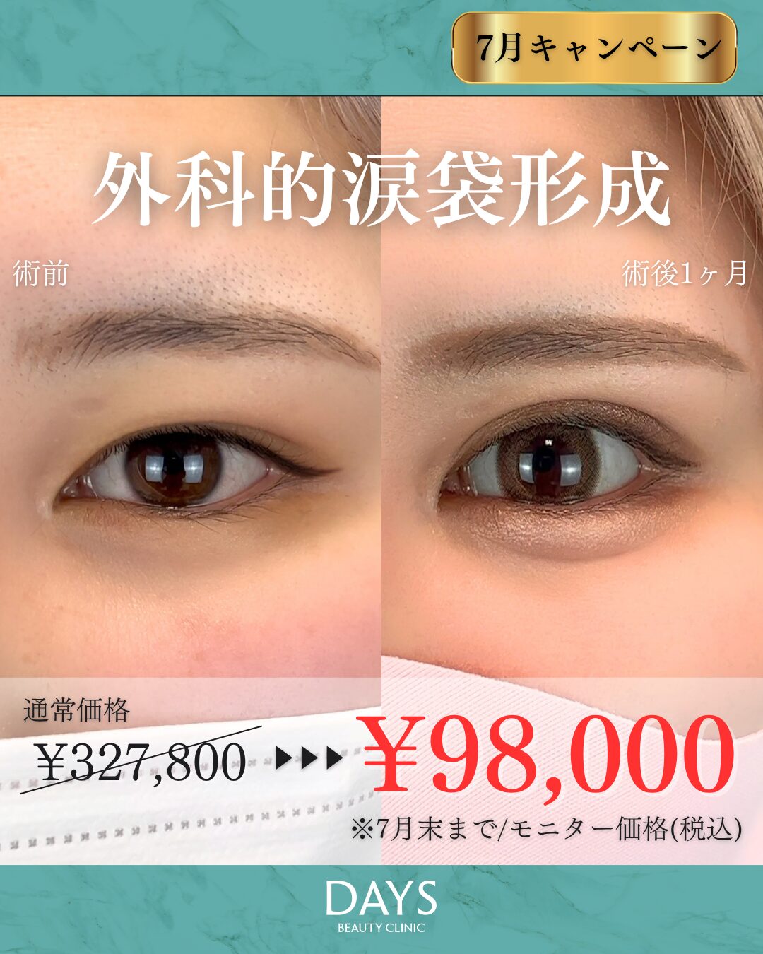 涙袋形成　岩井　2607