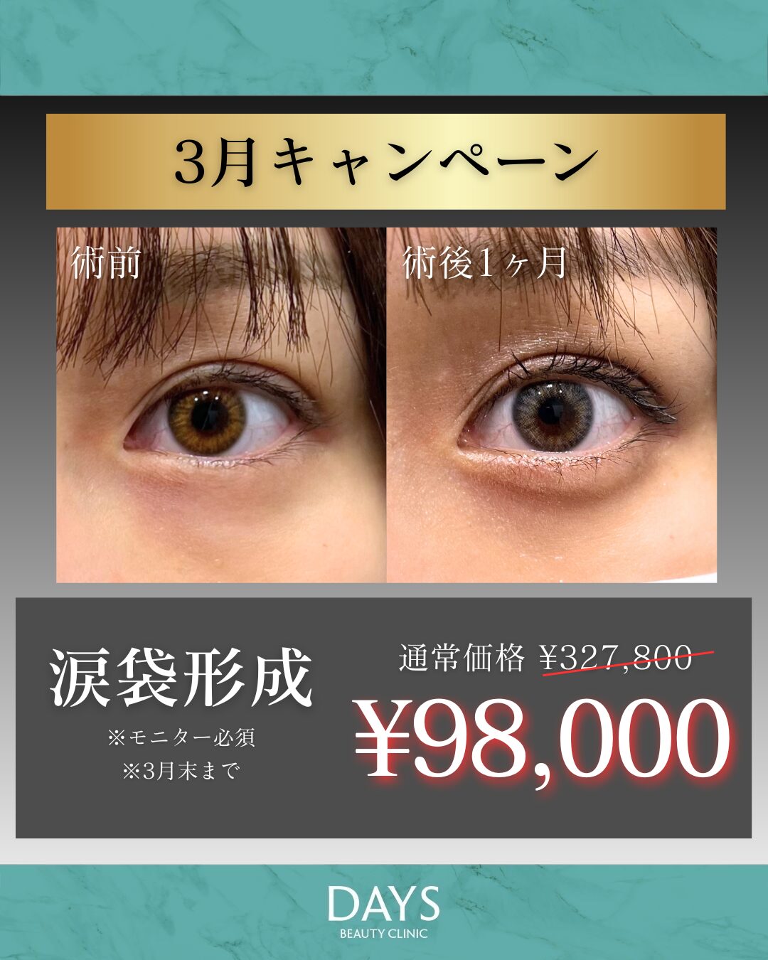 涙袋形成　岩井　2603