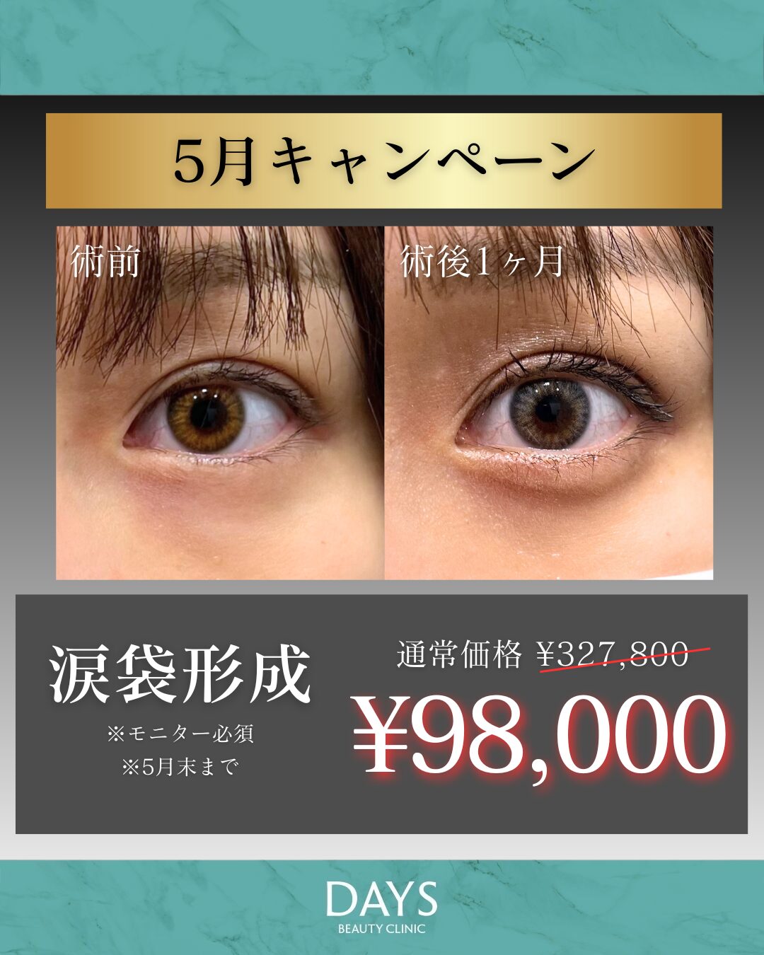 涙袋形成　岩井　2605