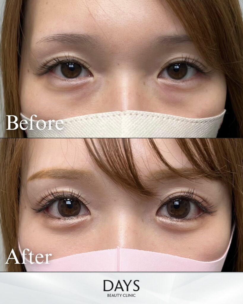 タレ目形成　症例　30代女性