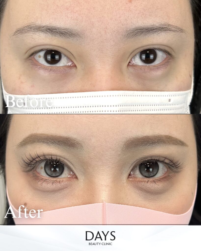 タレ目形成　症例　20代女性