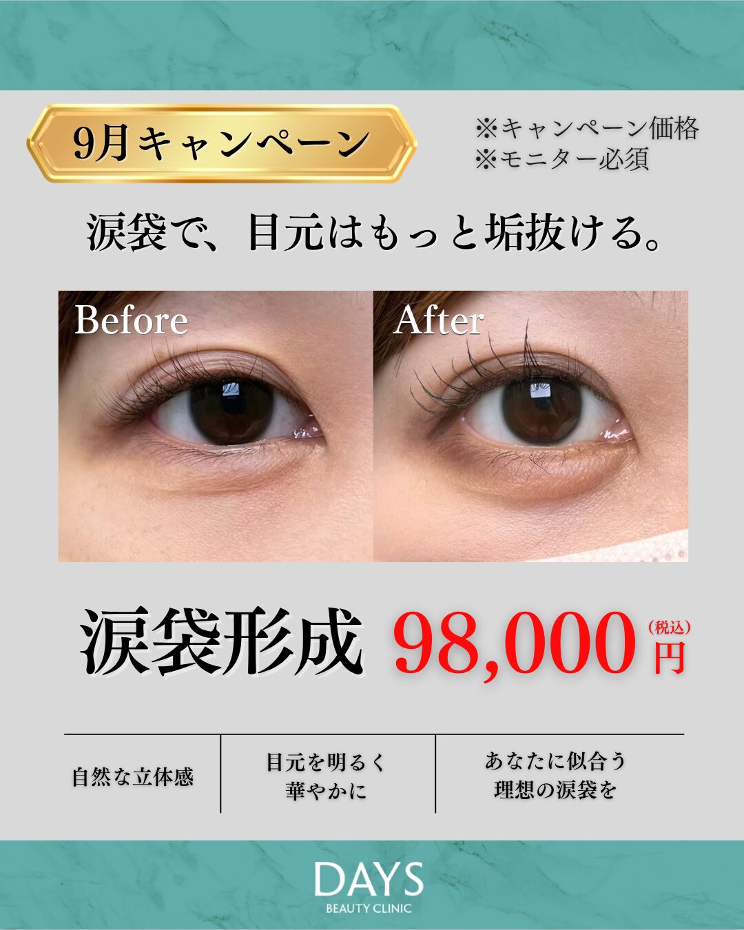 涙袋形成 須見 2609