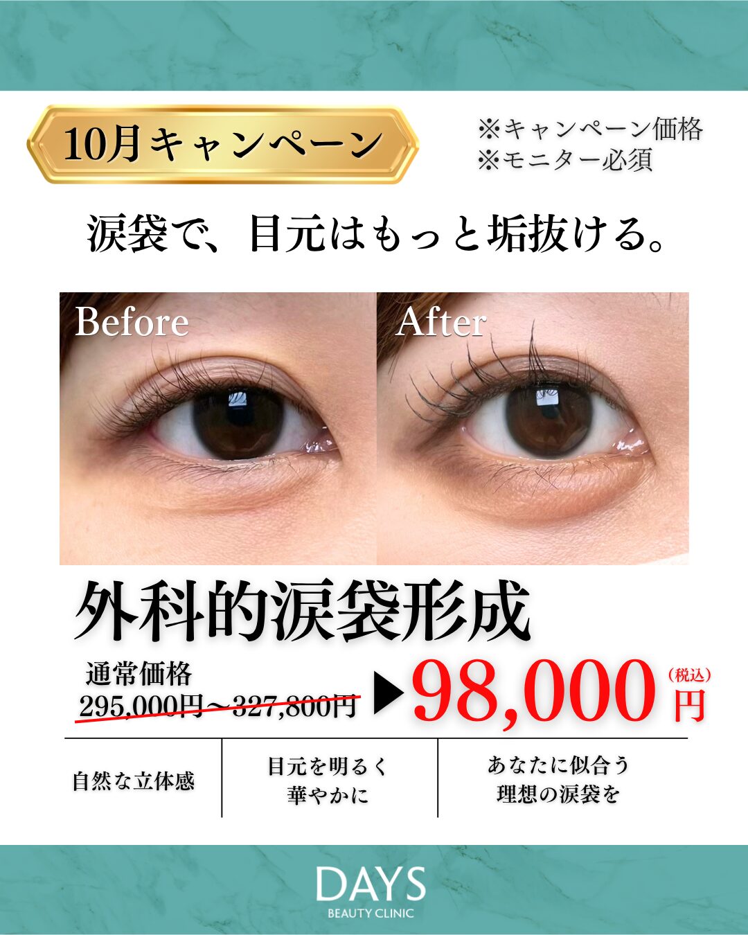 涙袋形成　須見　2610