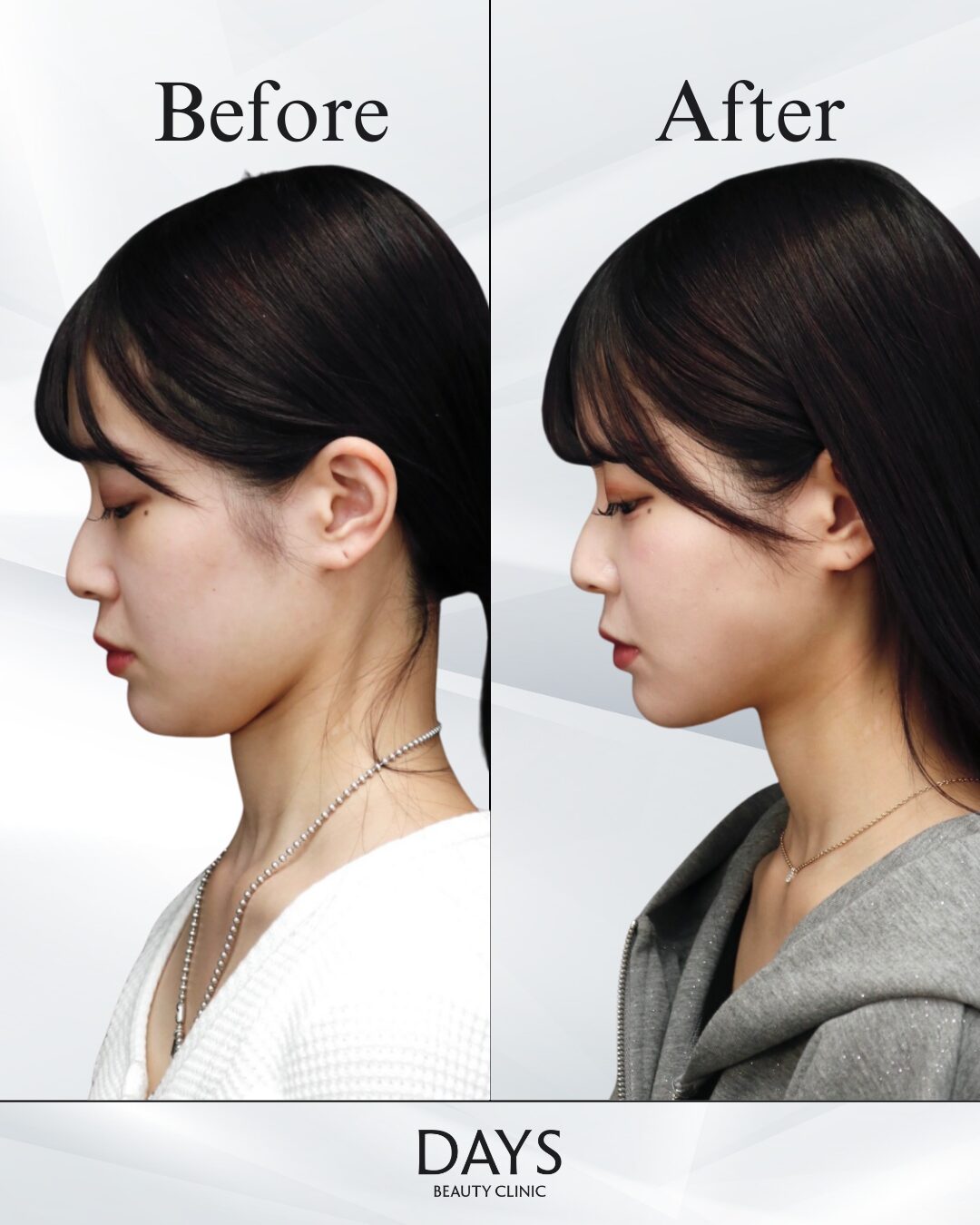 顔の脂肪吸引_糸リフト_ヒアルロン酸