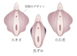 小陰唇縮小手術