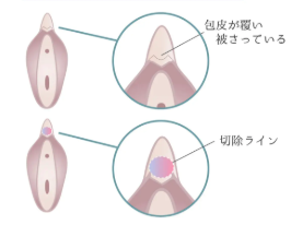 クリトリス包茎（陰核）手術
