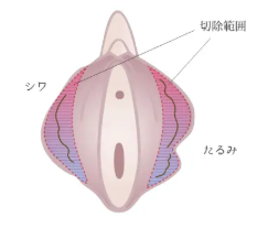 大陰唇たるみ除去手術
