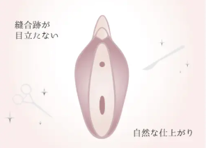 小陰唇縮小手術