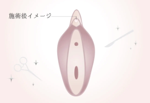 クリトリス包茎（陰核）手術