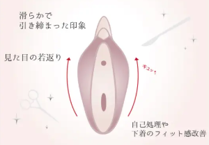 大陰唇たるみ除去手術