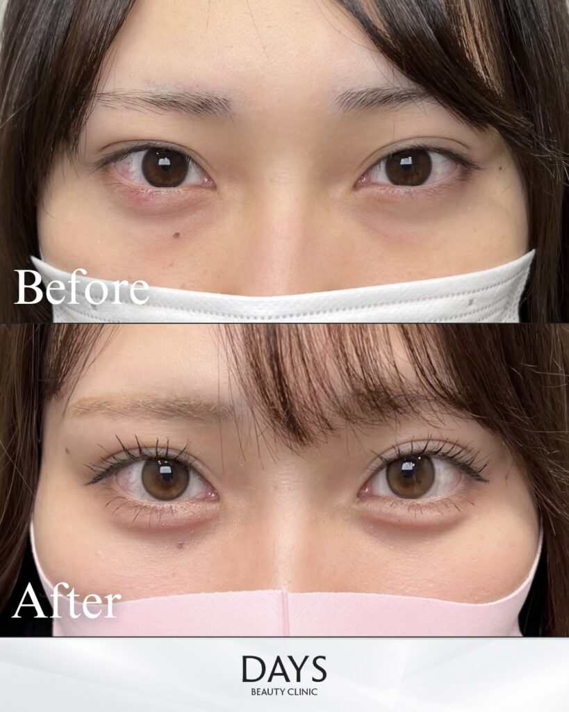 タレ目形成　症例　20代