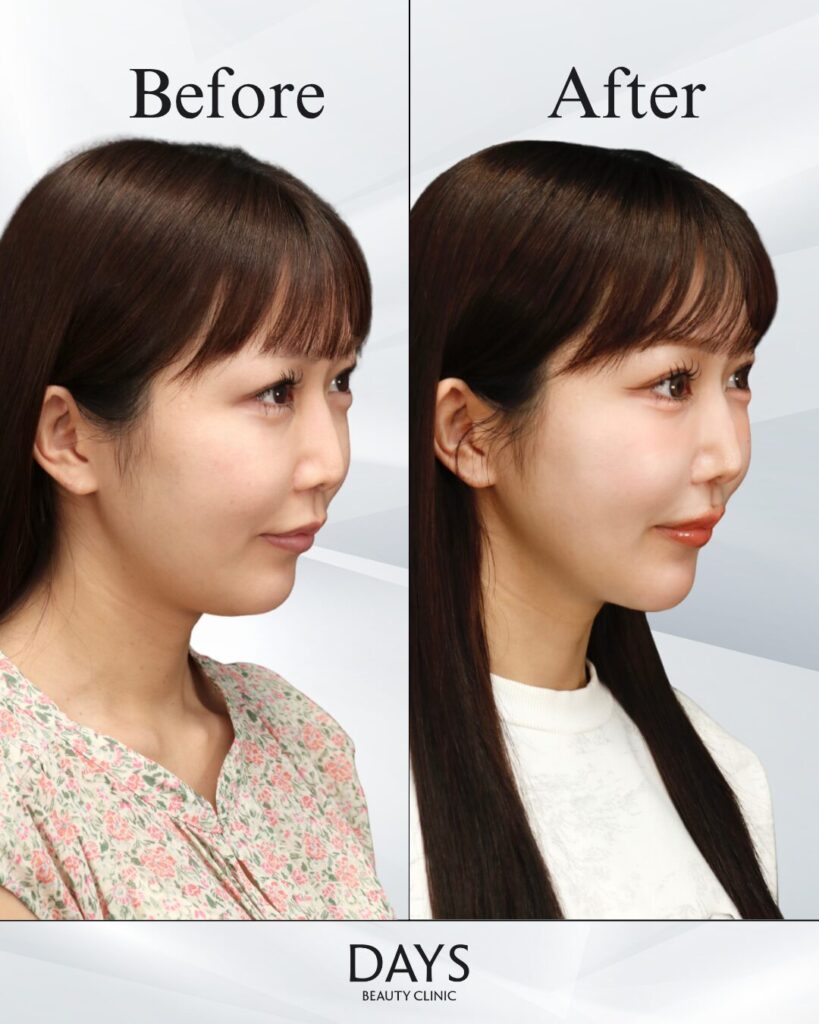 小顔　症例　20代女性