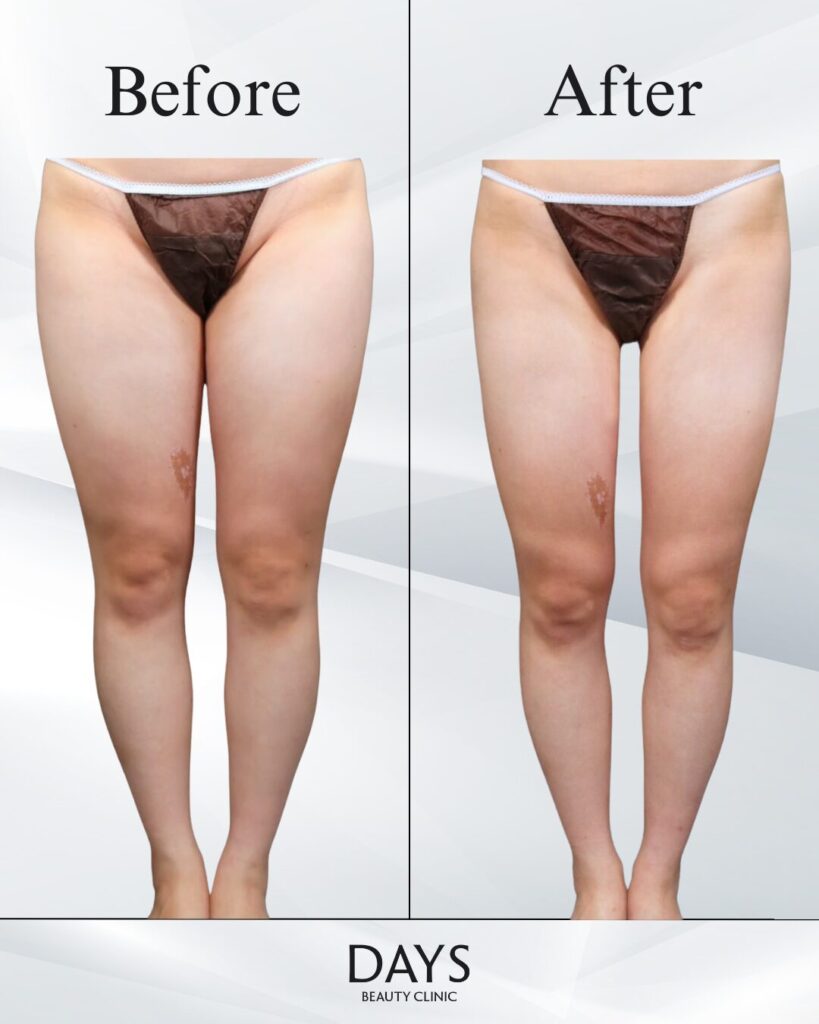 太もも脂肪吸引　症例　20代女性