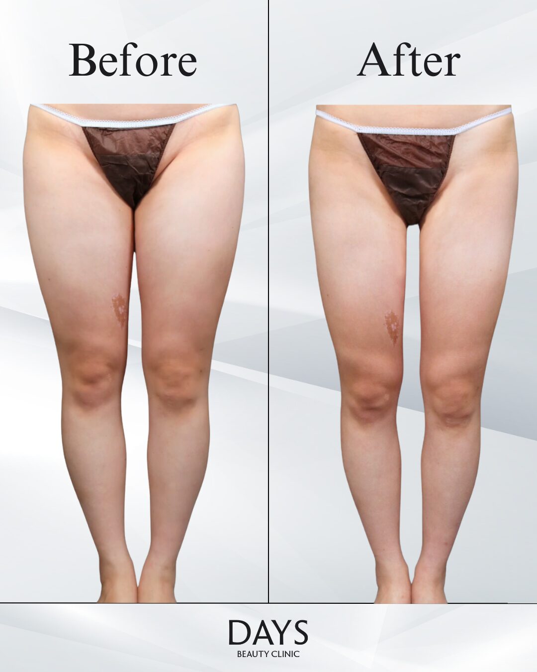 鍋田-森田症例-2-1