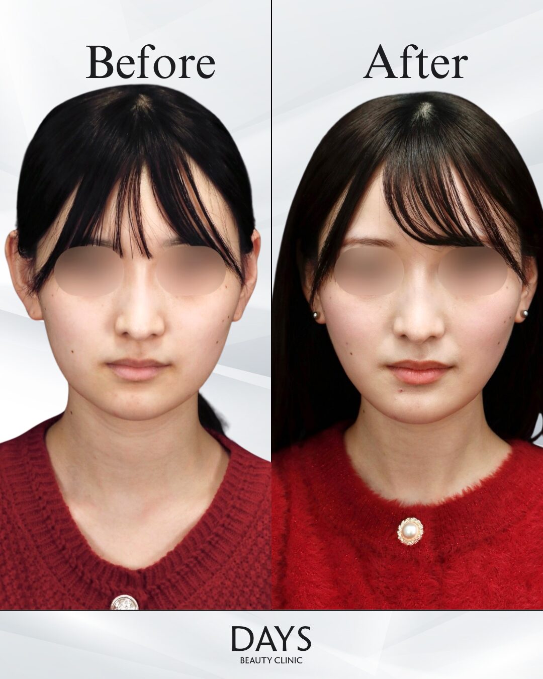 顔の脂肪吸引_BF