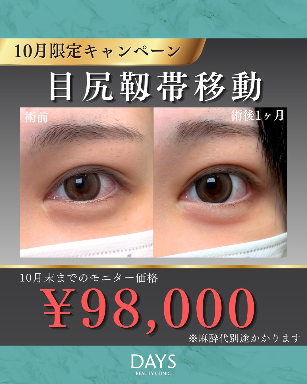 目尻靭帯移動　横田　2610