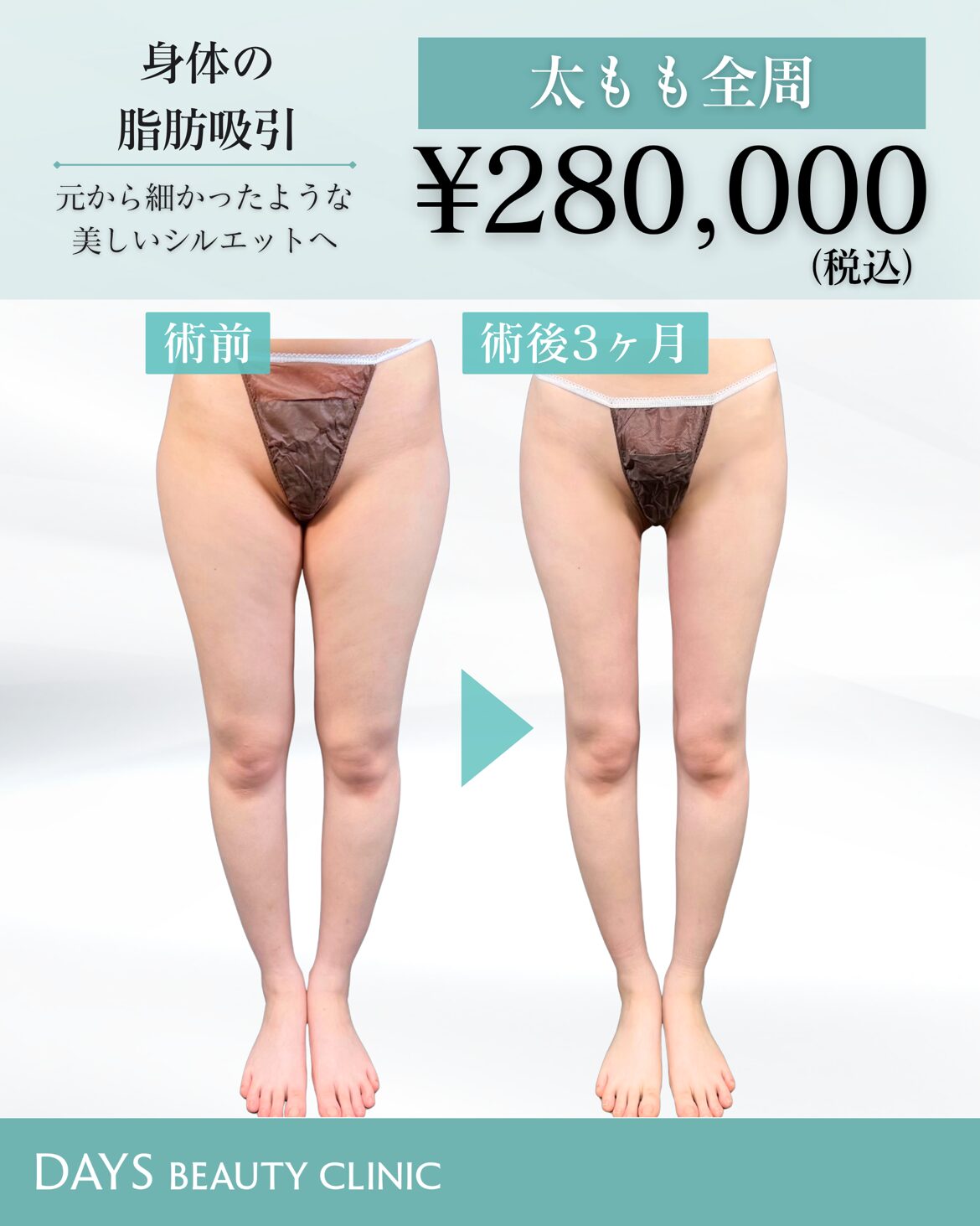 太もも脂肪吸引 藤塚 2609