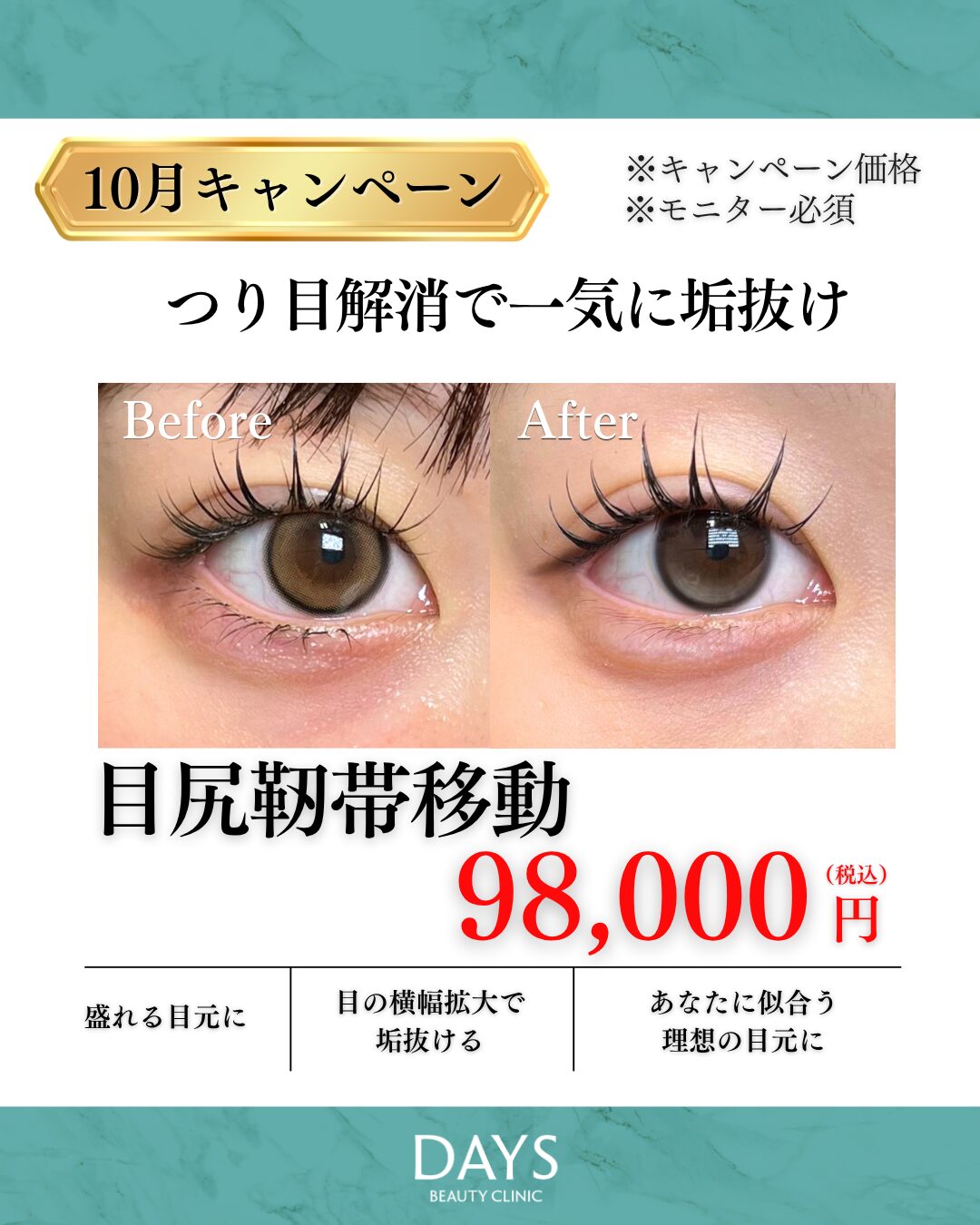 目尻靭帯移動　須見　2610