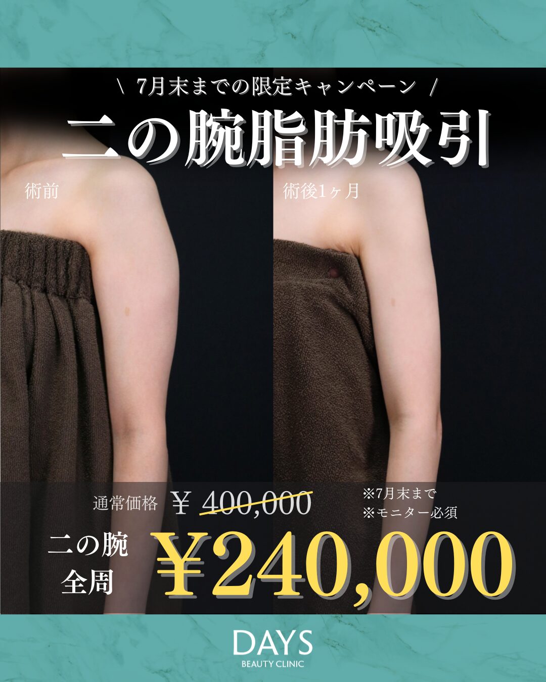 二の腕脂肪吸引　須見　2607