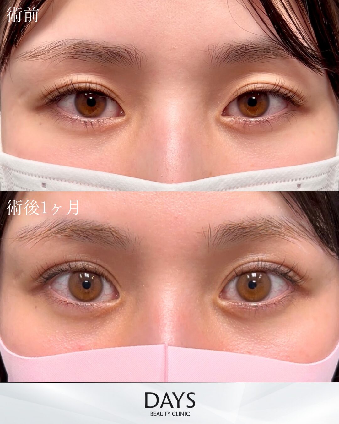 原田二重HP症例-2