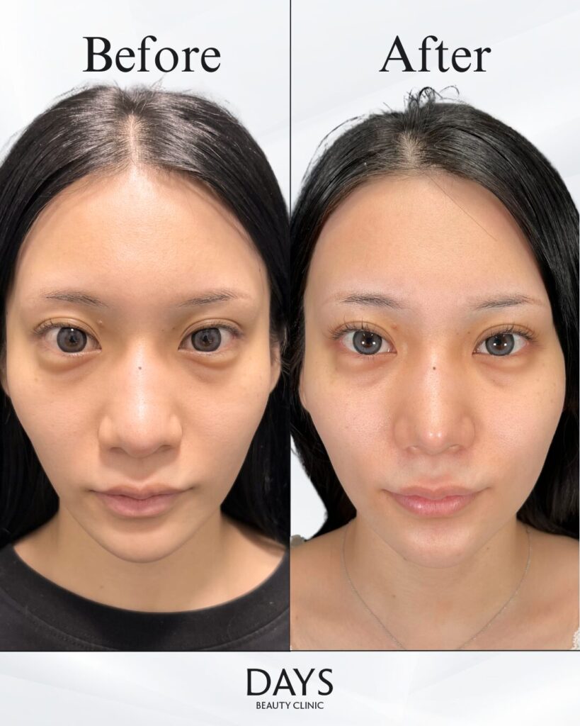 鼻施術　症例　20代女性